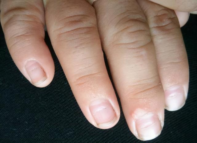 指甲有竖纹,横纹,淤青,月牙代表什么?几种指甲变化特征要了解
