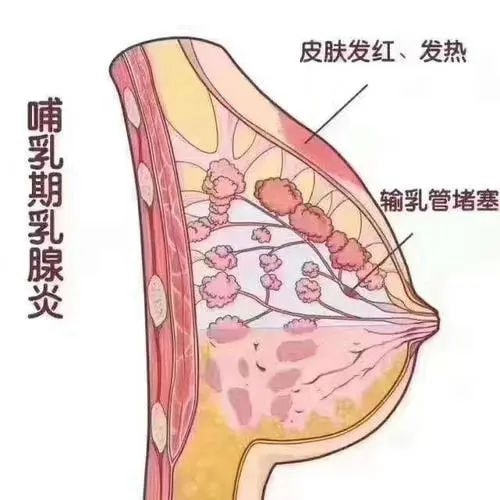 堵奶又被称为"乳腺管堵塞,乳汁淤积,由于产后喂奶不当,乳汁分泌过多