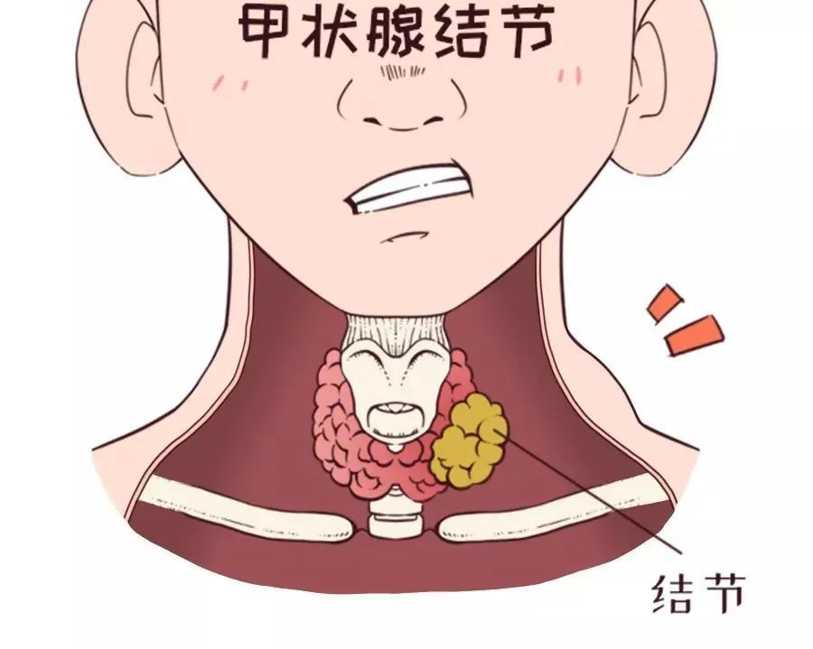 甲状腺肿大症状_甲状腺肿大吃什么_导致甲状腺肿大