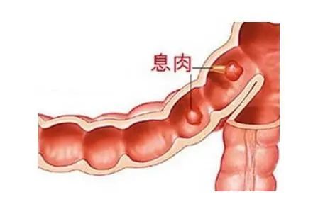 凡儿童有便血,大便次数及性质基本正常者,多为直肠息肉.