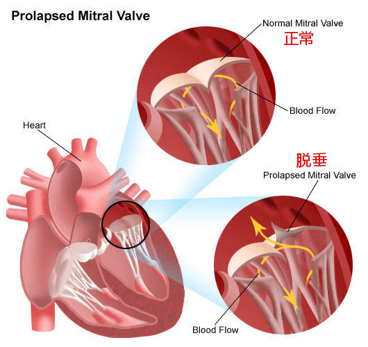 注: ,巴洛氏病(barlow病),松软二尖瓣(floppy mitral  valve),收缩