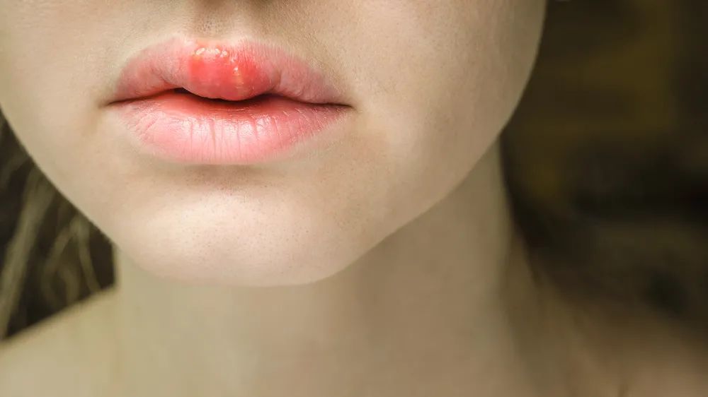嘴唇起疱多是单纯疱疹病毒感染导致,初次感染后病毒潜伏于神经节中,当