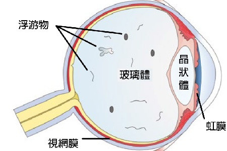 生理性飞蚊症:症状比较稳定,一般不影响视力,也不需要特殊的治疗