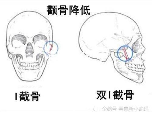 4点说明为什么张笑天做颧骨不下垂!