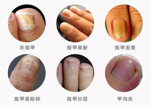 皮肤科专家凤仙花治疗灰指甲不拔甲不吃药30天指甲焕然一新