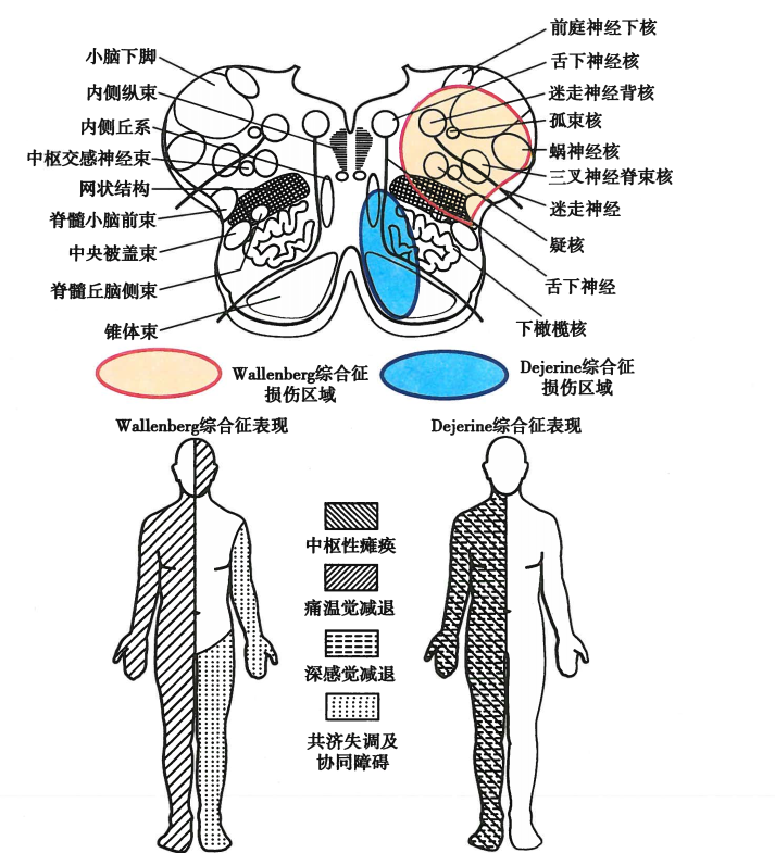 (1)延髓上段的背外侧区病变:可出现延髓背外侧综合征(wallenberg