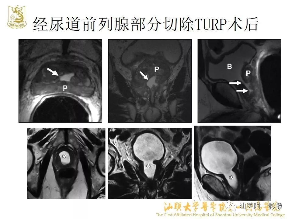 前列腺囊肿的影像诊断