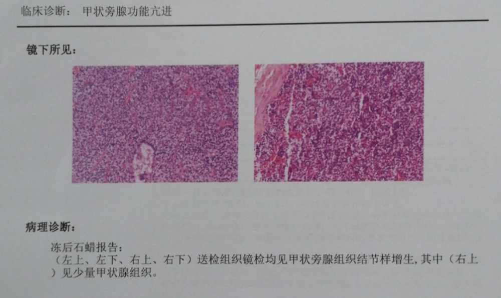 四个标本术中冰冻病理均提示为甲状旁腺组织结节样增生,随后取部分