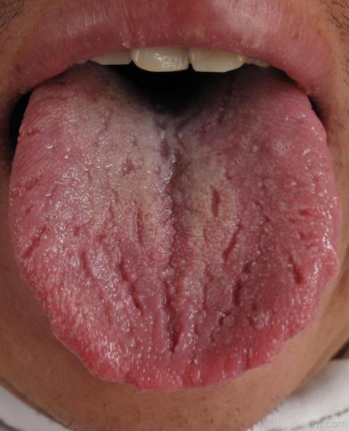 舌苔比较轻薄,如果舌苔发黄的话,可能是体内有湿热,舌苔厚白则有体寒