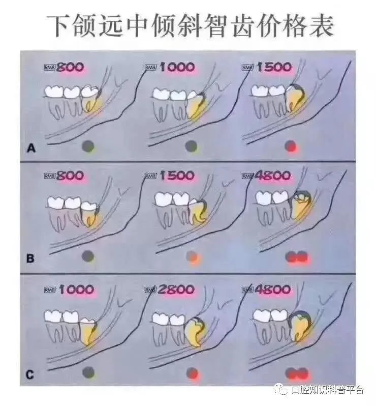 为啥拔智齿收费差别这么大?难道真有坑?
