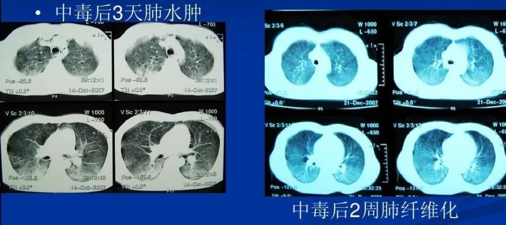 百草枯中毒后的反应往往是持续升级的.