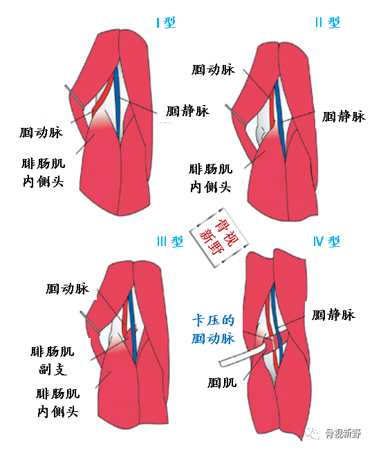 一文掌握|腘动脉卡压综合征