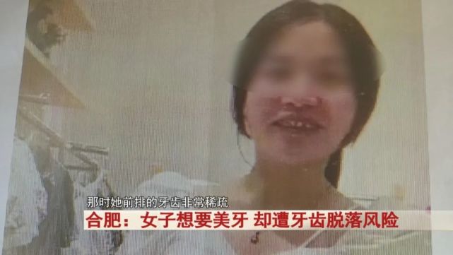合肥一女子做牙齿矫正,谁想牙缝却越来越大,将来还有可能