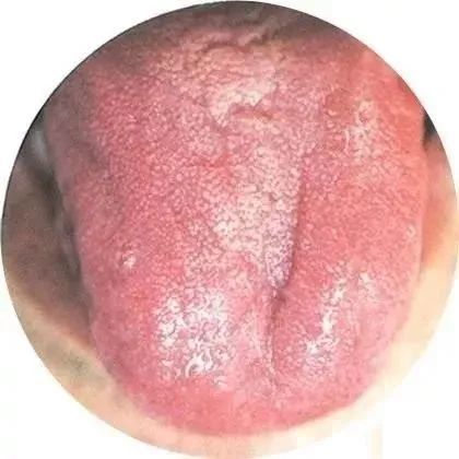 10暗红舌,薄白苔