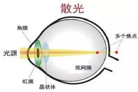 散光与复视有什么区别