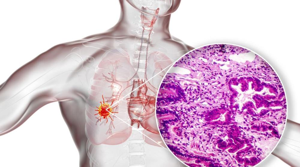 肺癌转移一般通过三种途径盘点肺癌最容易转移的六个部位