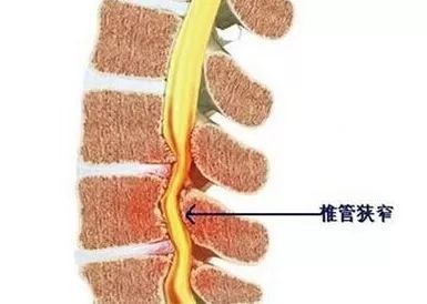 腰椎管狭窄症是一种由于先天或后天因素所致的腰椎椎管或椎间孔狭窄