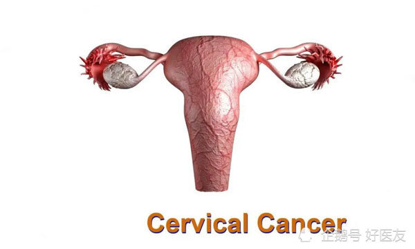 妇科头号癌症宫颈癌新疗法上市每年死亡超6万人