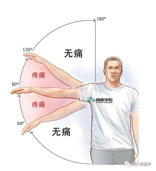 肩峰下撞击综合征的症状和治疗