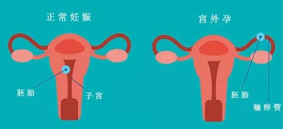 她怀上四胞胎竟然两个在宫内两个在宫外怎么办