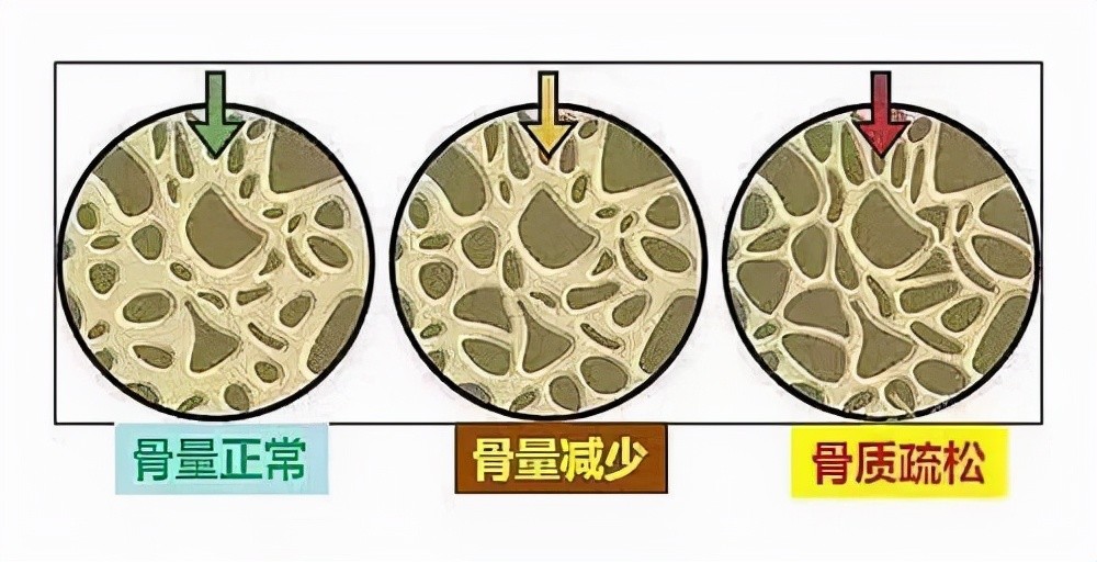 腰酸背疼,弯腰驼背,容易骨折?防治骨质疏松,这篇文章全说清