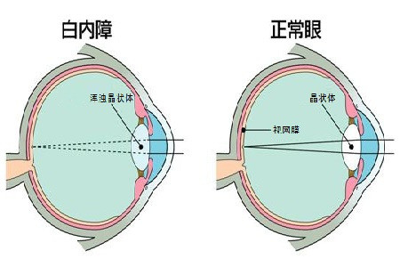 老年性白内障分哪些种