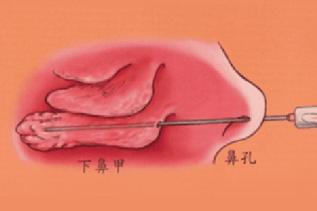 下鼻甲肥大的临床表现