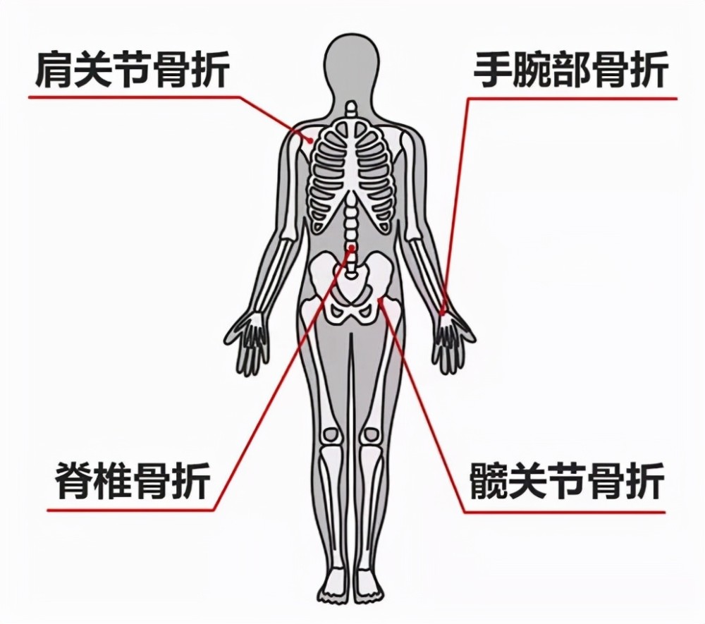 骨质疏松常见骨折部位