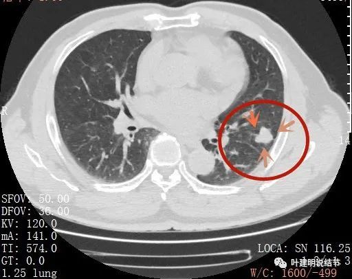 10.20:两肺广泛实性结节会是不是癌症晚期没救了?