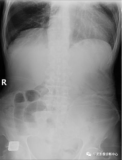 一文让你掌握,肠梗阻x线表现