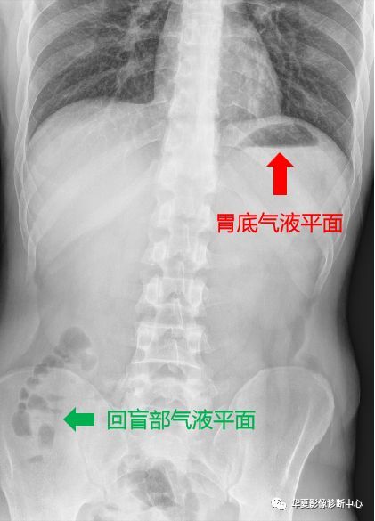 一文让你掌握肠梗阻x线表现