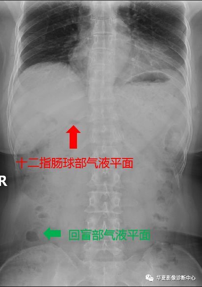 回肠末段及结肠胃底腹部常见的正常气-液平面幽门梗阻呕吐物的特点