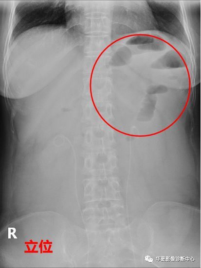 一文让你掌握,肠梗阻x线表现