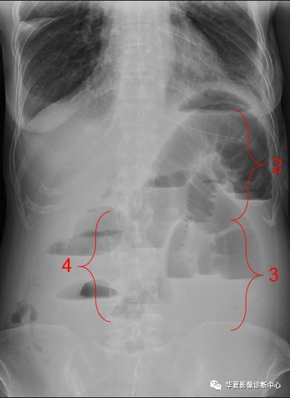 一文让你掌握,肠梗阻x线表现