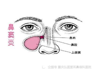 重庆弘医堂医院分享鼻窦炎的出现有哪些危害