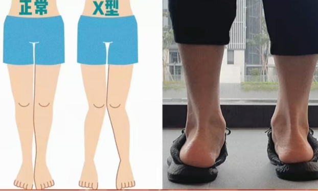 足外翻的危害远不只使人的体态看起来不美观这么简单,久而久之还会使