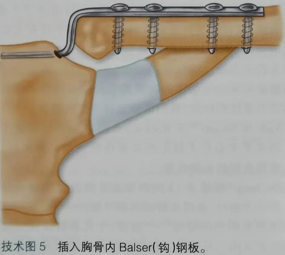 它已被用于治疗胸锁关节脱位,钢板的钩抽入胸骨,并用螺钉将近端锁骨