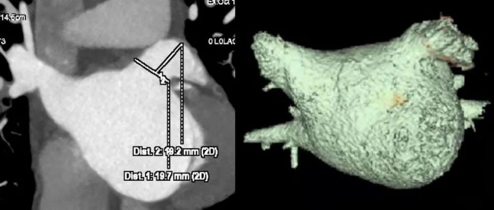 术前 ct 检查,左心耳呈鸡翅型