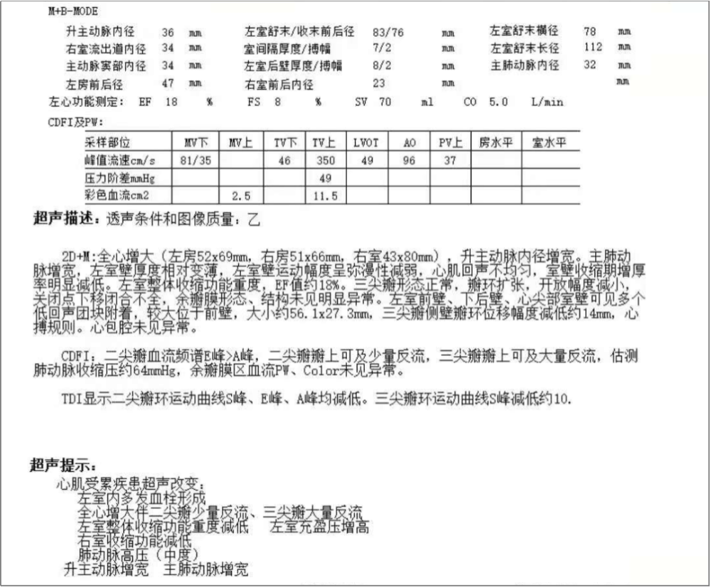 精彩病例丨cdqi名家面对面第五十六期扩张型心肌病合并左室血栓一例