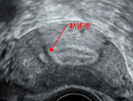 超声下时有时无的宫腔粘连