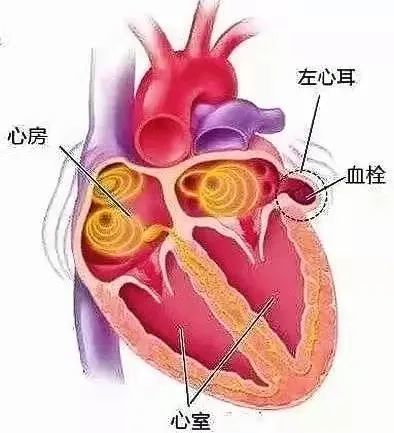 七旬奶奶心脑肾三连梗医生封堵心脏的小耳朵巧解忧