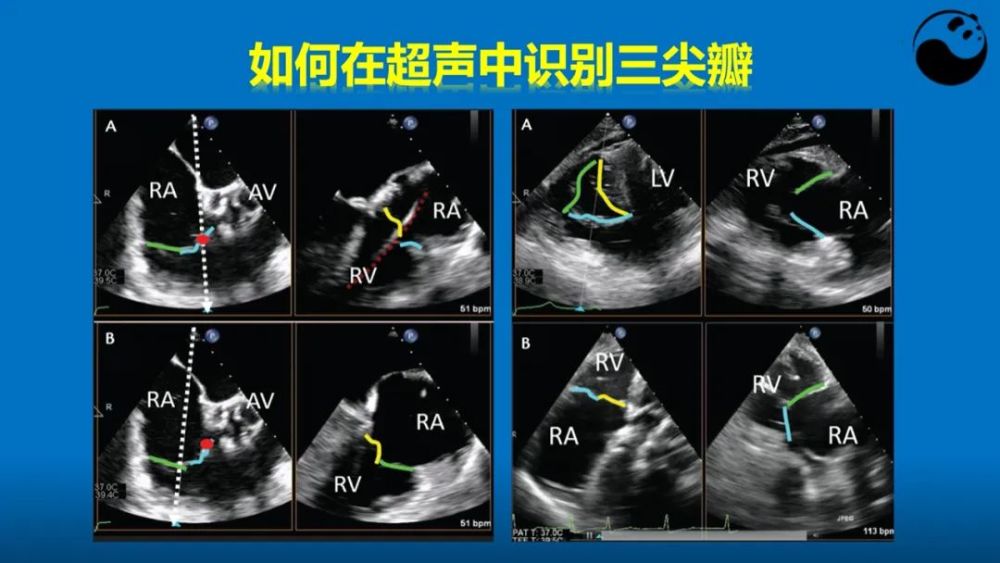 学好超声心动图,应掌握的心脏解剖知识
