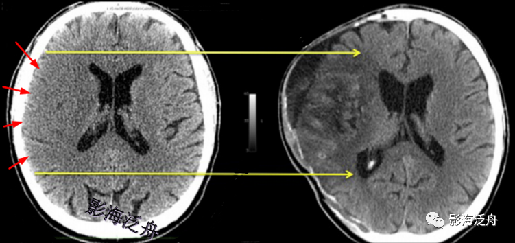 夜班不求人急性脑梗死的ct诊断