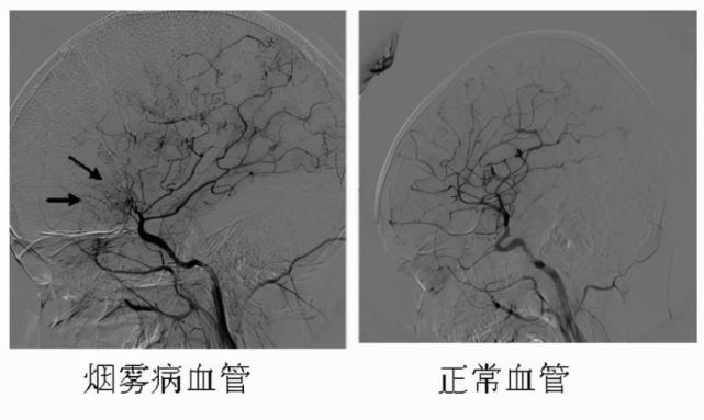 烟雾病的中医治疗思路分析