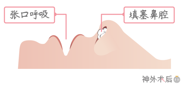 垂体瘤患者由于术后鼻腔填塞,需经口吸氧,张口呼吸.