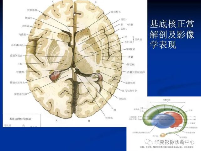 基底节深部核团疾病的诊断与鉴别诊断