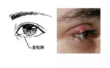 一旦发生眼眶蜂窝织炎,应立即就医,如不加以重视,则会 引起视力下降