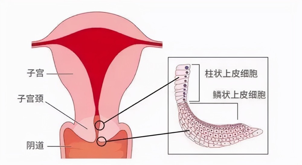 宫颈管上,有两种不同类型的细胞—— 鳞状上皮细胞,柱状上皮细胞.