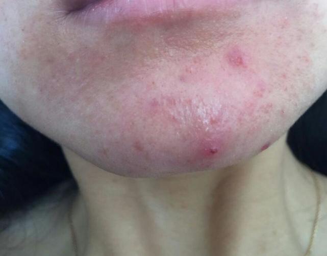长春肤康医院浅谈:激素性皮炎有哪些症状?患者应如何?