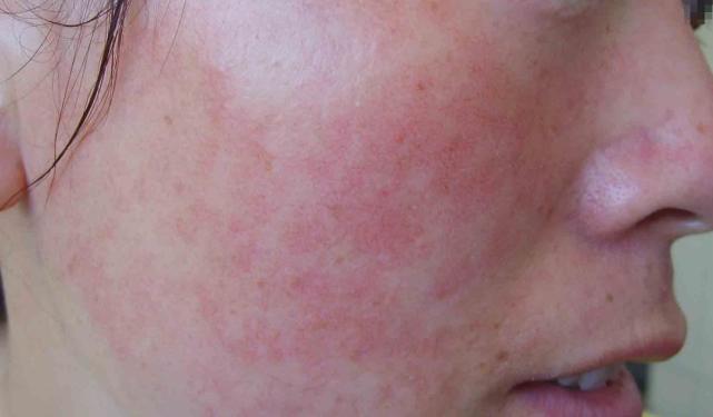 长春肤康医院浅谈:激素性皮炎有哪些症状?患者应如何?